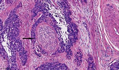 Survival Impacts of Perineural Invasion on Patients Under Different Radical Hysterectomies Due to Early Cervical Cancer